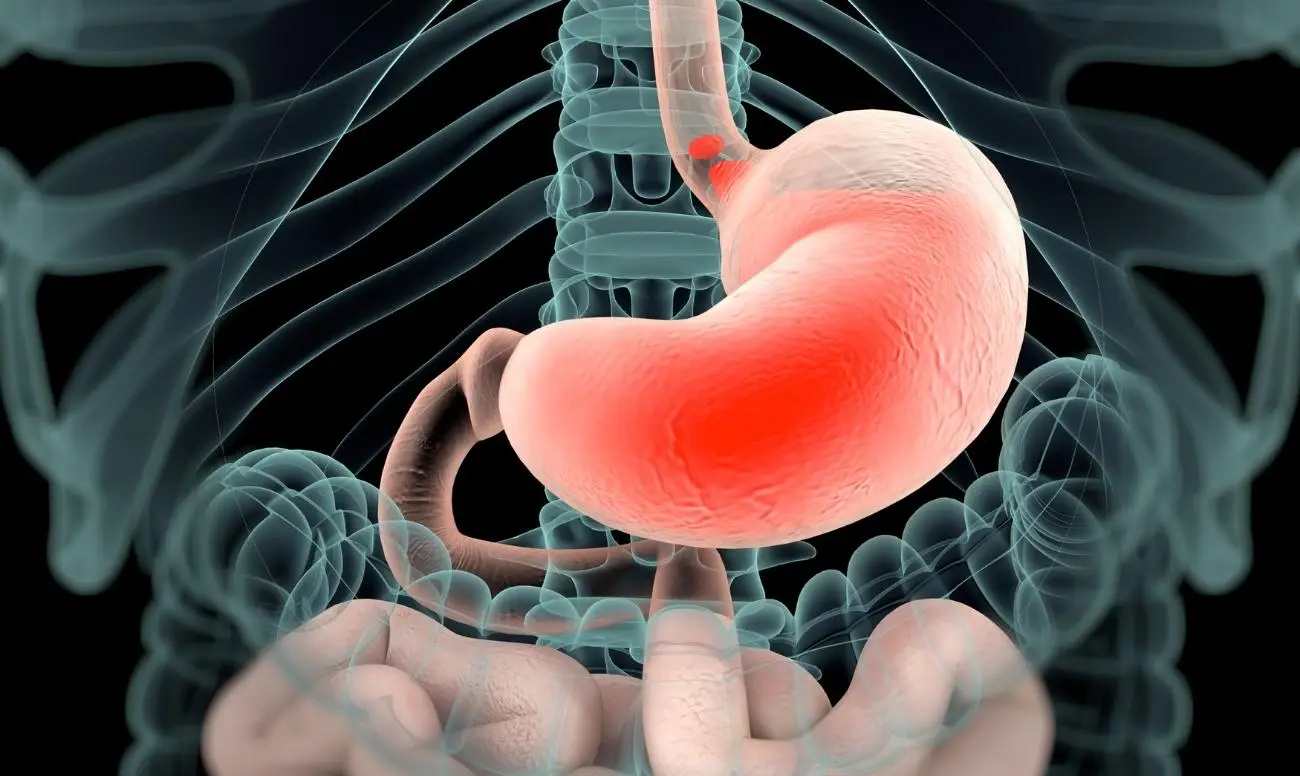 Bruciore allo stomaco? Ecco i segnali silenziosi che indicano che potresti avere la gastrite